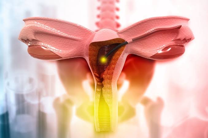 Hysterectomy