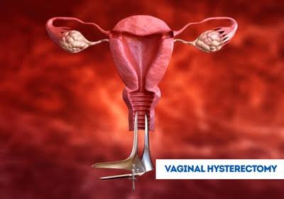 Vaginal Hysterectomy