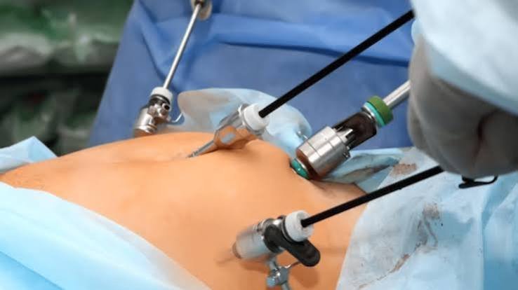 Laparoscopic Surgery