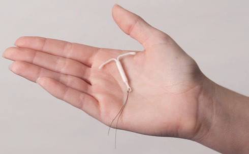 Mirena (Hormonal IUD)
