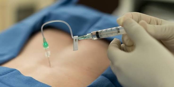 Epidurals